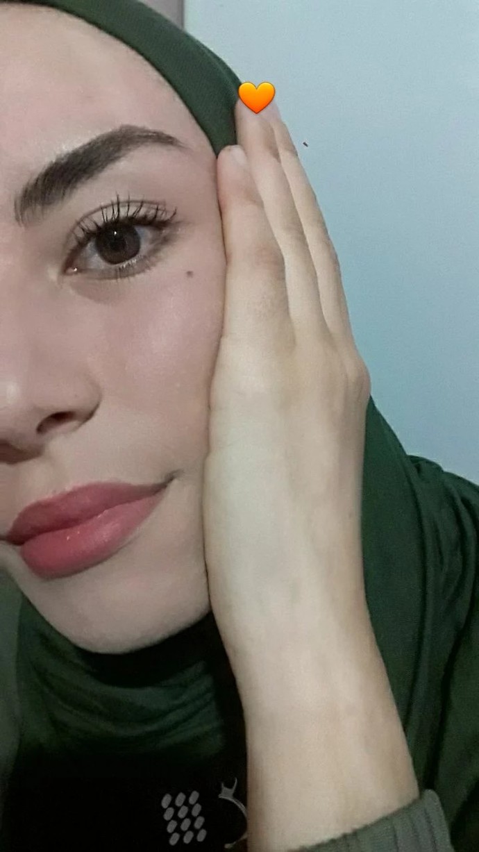 Gözümün altındaki ben için herkes kötü duruyor diyor. Sizce aldırmalı mıyım?