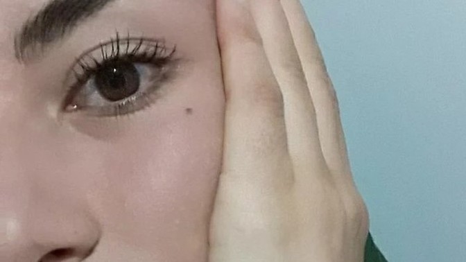 Gözümün altındaki ben için herkes kötü duruyor diyor. Sizce aldırmalı mıyım?