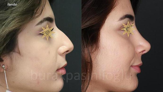 Burun estetiği yaptıran birinin eski fotoğraflarını sosyal medyadan kaldırması normal mi?