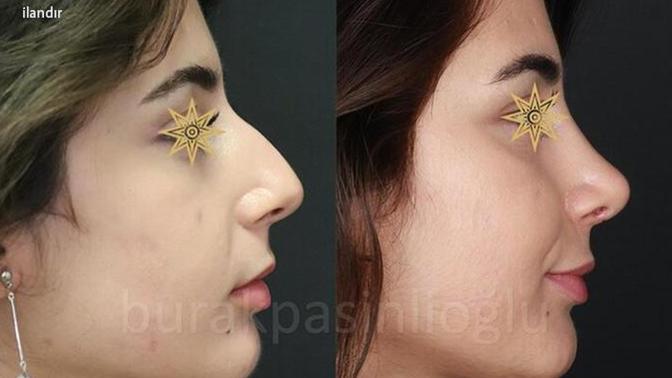 Burun estetiği yaptıran birinin eski fotoğraflarını sosyal medyadan kaldırması normal mi?