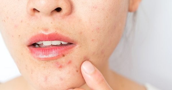 Sivilce tedavisinde doğal yollara mı yoksa tıbbi tedaviye mi güveniyorsunuz?