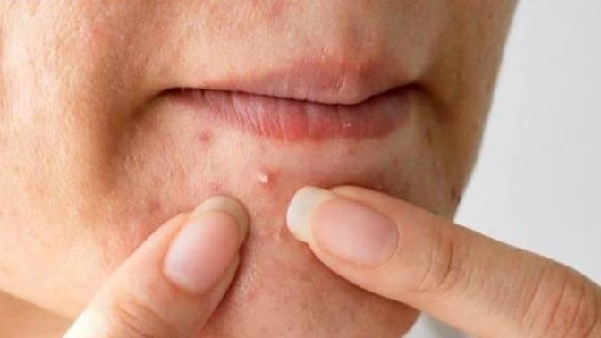 Yüzde çıkan sivilceleri sıkmak leke oluşumu yapar mı?