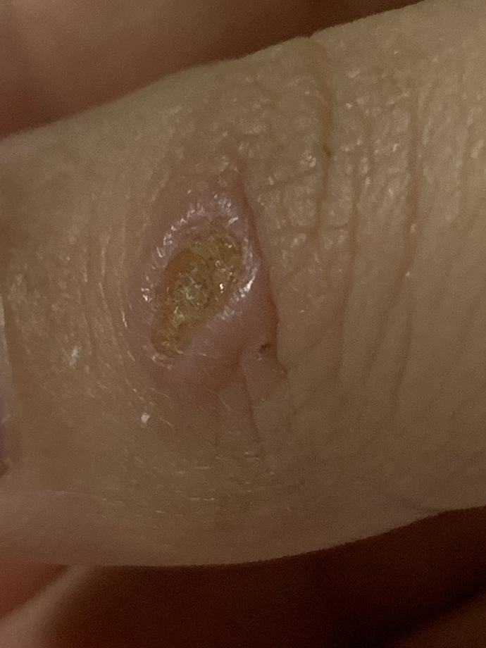 Parmağımı rendeledim böyle bişeye dönüştü iyileşir mi?
