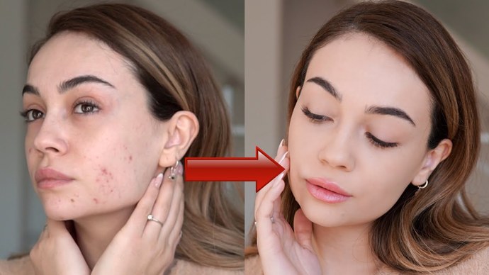 Sivilceleri kapatıcıyla gizleyip dışarı çıktığınız oldu mu?