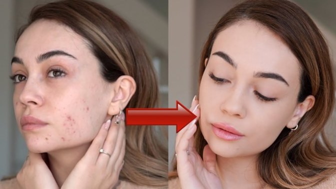 Sivilceleri kapatıcıyla gizleyip dışarı çıktığınız oldu mu?