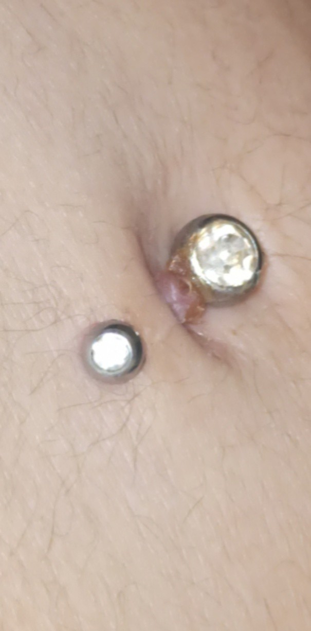 Piercingim böyle oldu napmalıyım bildiğin etim dışarı çıktı çok acıyor ve hep kabuk bağlıyor?