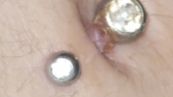 Piercingim böyle oldu napmalıyım bildiğin etim dışarı çıktı çok acıyor ve hep kabuk bağlıyor?