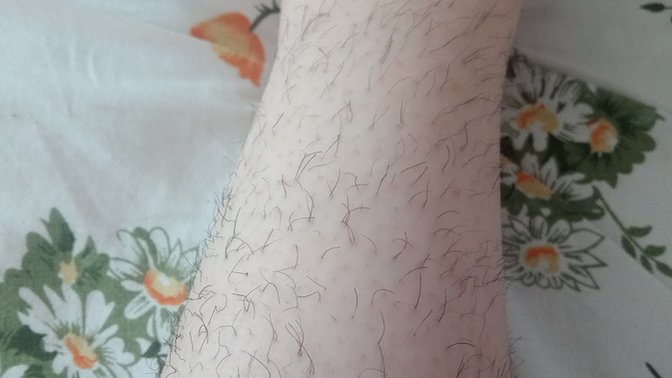 Bacaklarımı jiletle alıyordum. Böyle oldular, ne yapsam düzelir?