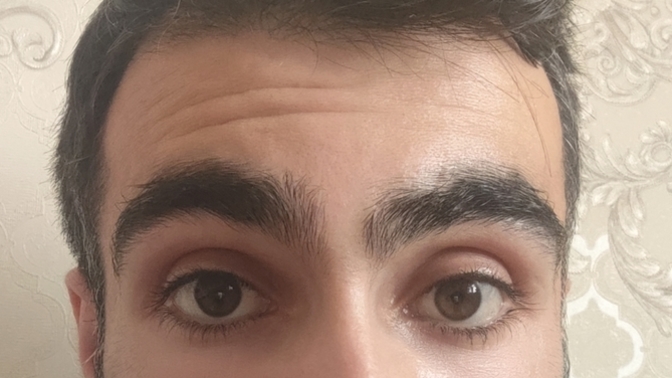 Sol gözümde katarakt var sizce tehlikeli mi arabir sol göz kapağında az bir şişlik oluşuyor ve kendinden geçiyor?