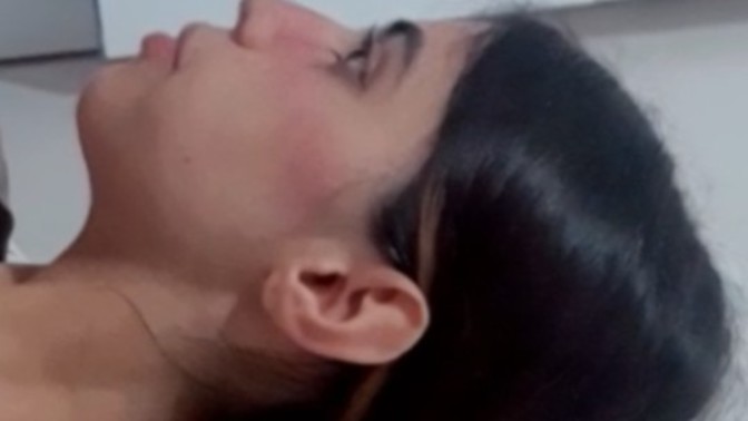 Burnuma dolgu yaptırsam düzelir mi?