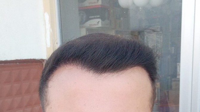 Sac ektirdim nasıl olmuş değişim var mi?