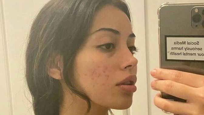 Güzel olmak için illaki bebek gibi cilde sahip olmaya gerek var mı?