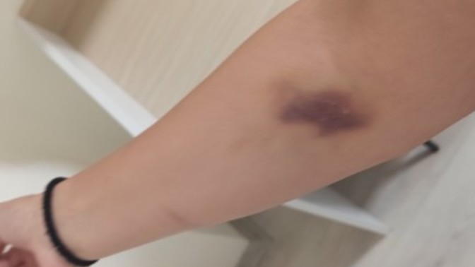 Bir hafta önce kolumdan kan alındı kan grubunu öğrenmek için bu morluk geçmedi hâlâ neden?