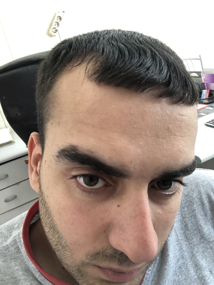 Saçlarım git gide açılıyor saç ektirmekmi protez saçmı daha kalıcı yöntemdir?