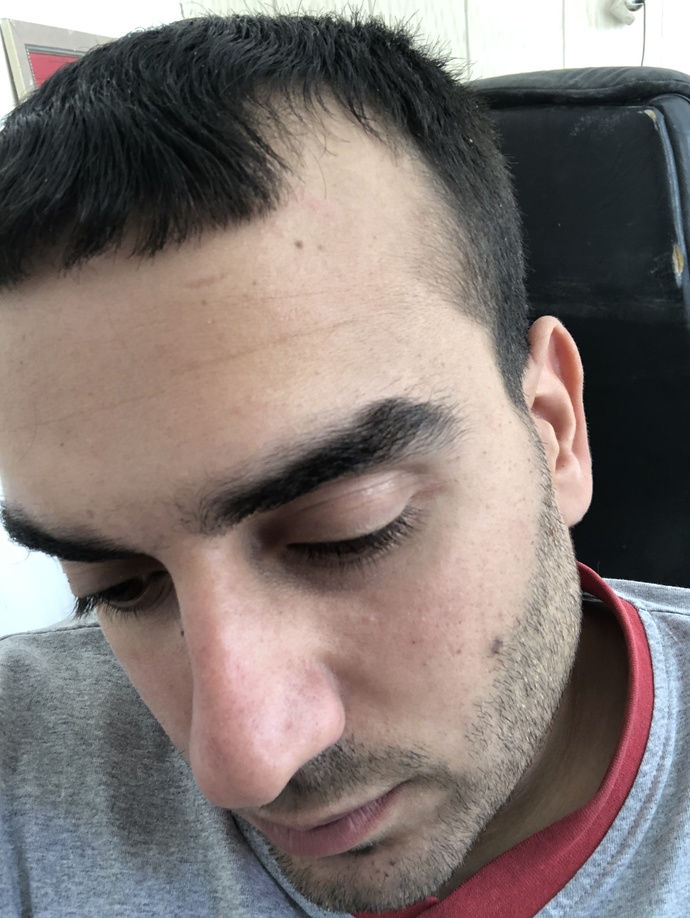 Saçlarım git gide açılıyor saç ektirmekmi protez saçmı daha kalıcı yöntemdir?