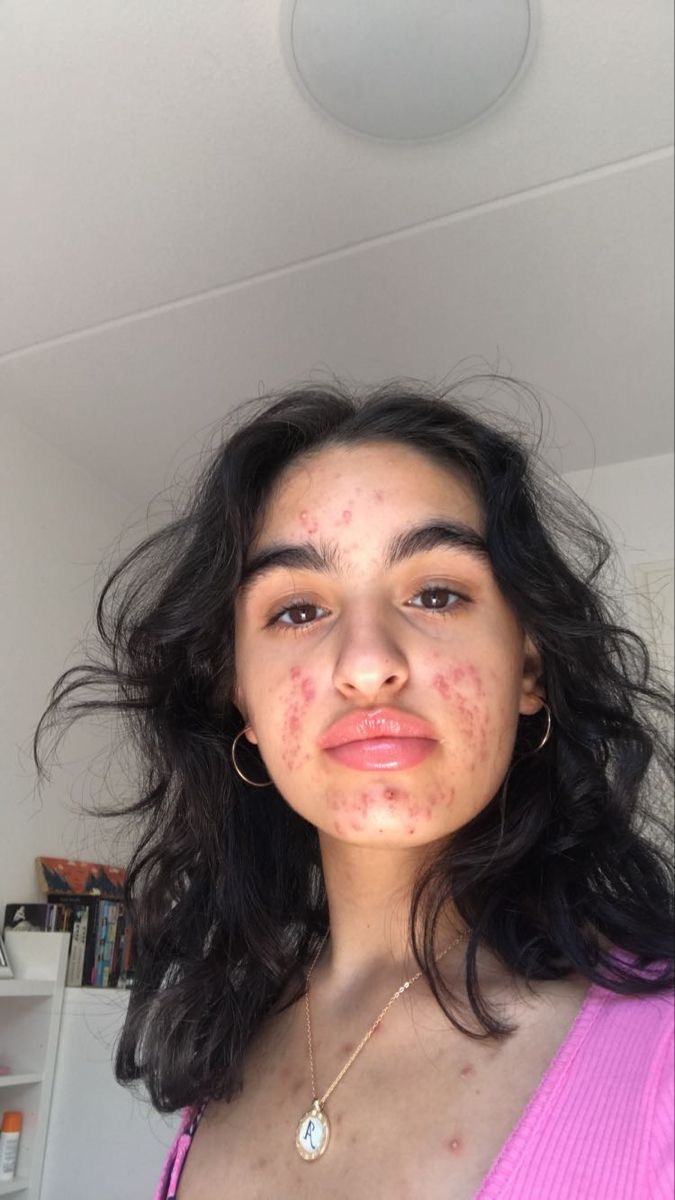 Aknelerden kurtulamıyorum. Senin kurtulamadığın cilt problemi hangisi?