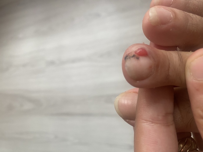 Tırnağımda böyle bir şey çıktı, bu nedir?