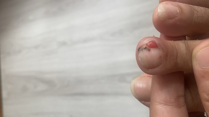 Tırnağımda böyle bir şey çıktı, bu nedir?