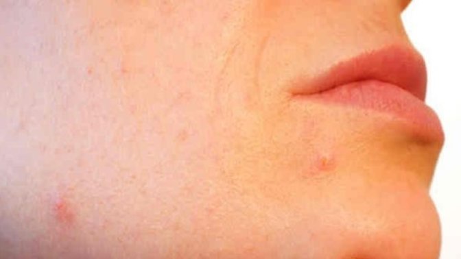 Sivilce oluşumunu engellemek için yaptığınız bir rutin var mı?