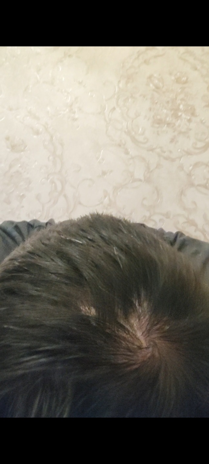 Sizce saçlarımda kı bu durum nedir neyin alemetidir?