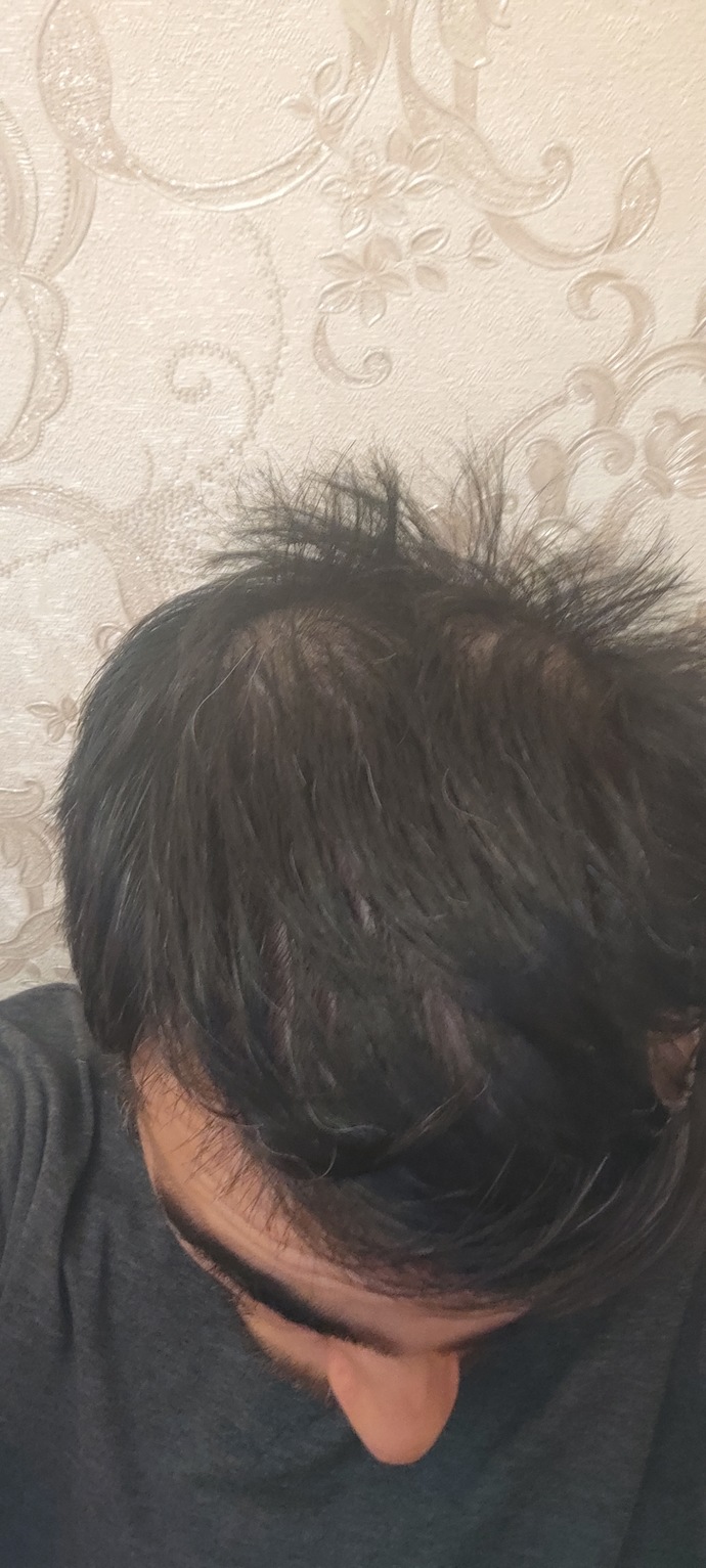 Sizce saçlarımda kı bu durum nedir neyin alemetidir?
