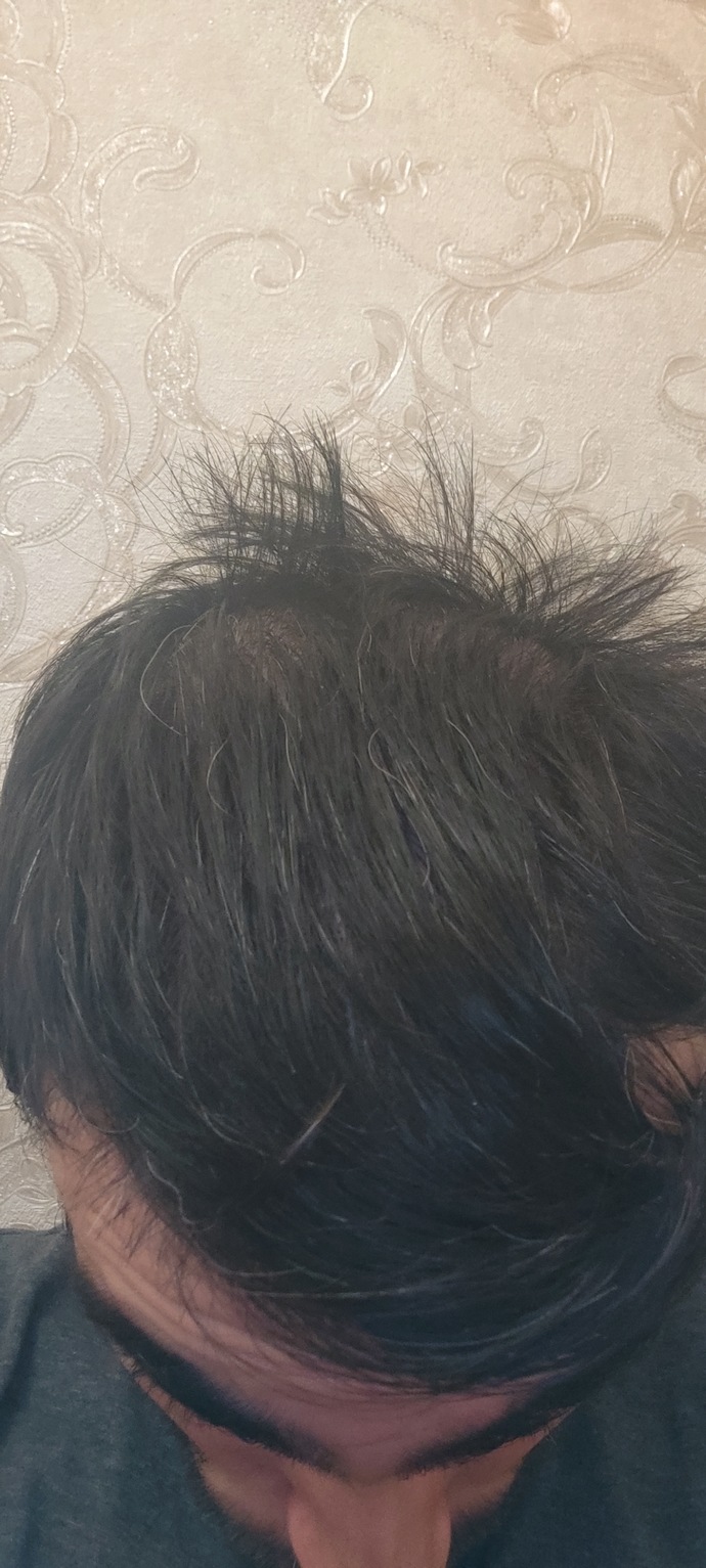 Sizce saçlarımda kı bu durum nedir neyin alemetidir?