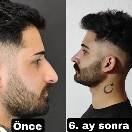 Burun estetiği oldum. Sizce sonuç nasıl?
