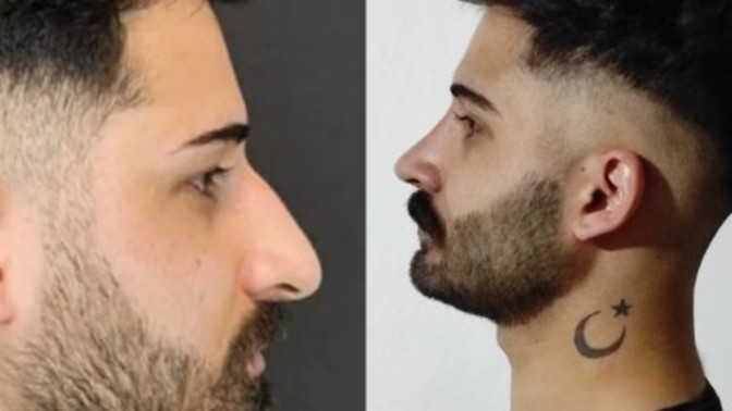 Burun estetiği oldum. Sizce sonuç nasıl?