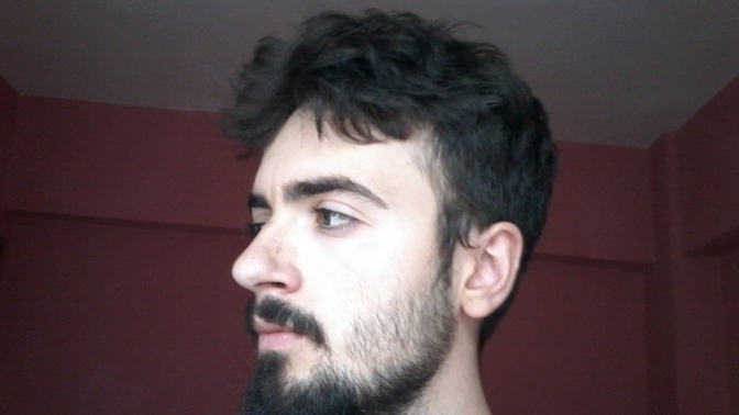 Saçın yanlarındaki seyrelme kalıcı mıdır?