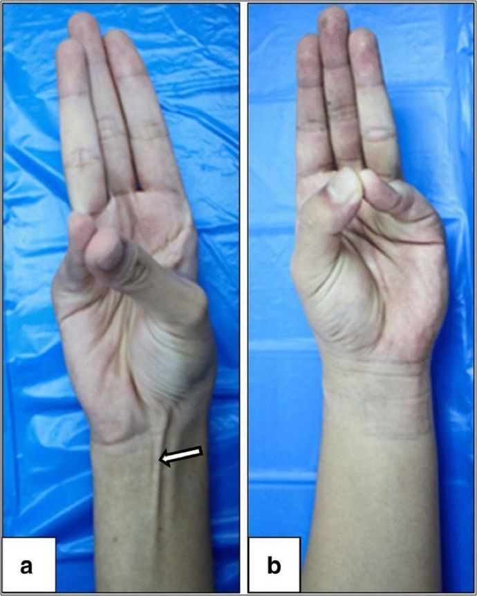 Öğrenmek İçin bu hareketi yapmayı deneyin. Palmaris Longus kasınız var mı?