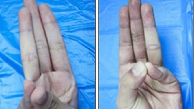 Öğrenmek İçin bu hareketi yapmayı deneyin. Palmaris Longus kasınız var mı?