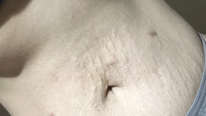 Karnımda çatlaklar ve izler var ama flörtümle aramızda olağanüstü bir çekim de var. Sizce çekinmeli miyim?