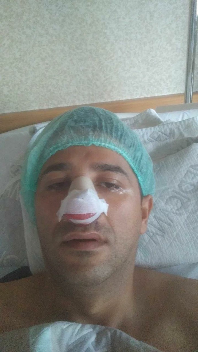 Merhaba arkadaşlar Burun ameliyatı olanınız var mı?