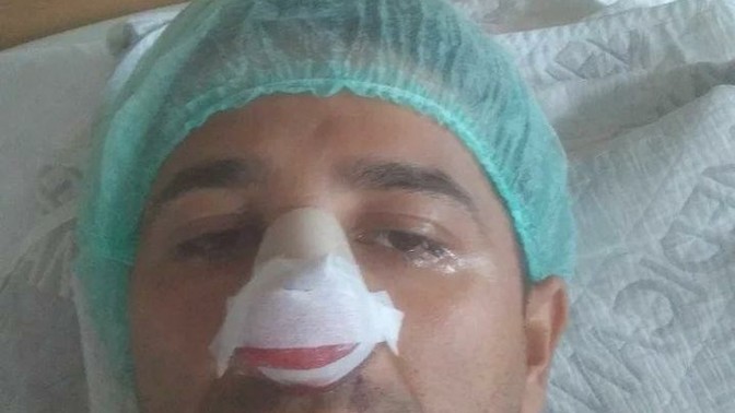 Merhaba arkadaşlar Burun ameliyatı olanınız var mı?