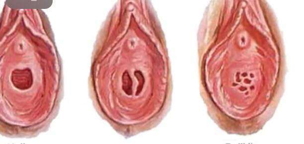 Kızlık zarı diğer bir adıyla bekaret zarı gerçekten var mı?