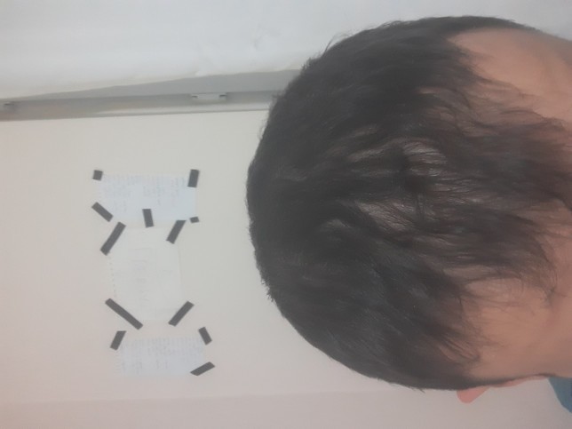 16 yaşımdan beri saçlarım dökülüyor, şu an 18 yaşındayım ve hal böyle. Ne yapacağım ben?