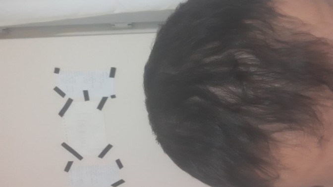 16 yaşımdan beri saçlarım dökülüyor, şu an 18 yaşındayım ve hal böyle. Ne yapacağım ben?