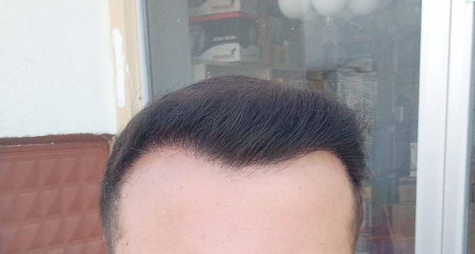 Saç ekimi işlemi nasıl olmuş?
