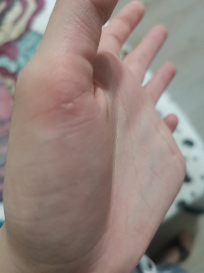 Ütüdrn elimi çok fena yaktım, yardımm😭?