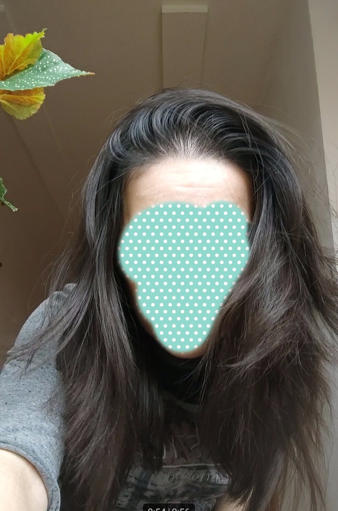 Her gün aynaya bakarken ağlıyorum, bu saç dökülmem nasıl duracak?