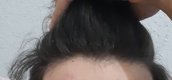 Saçım seyrek mi?