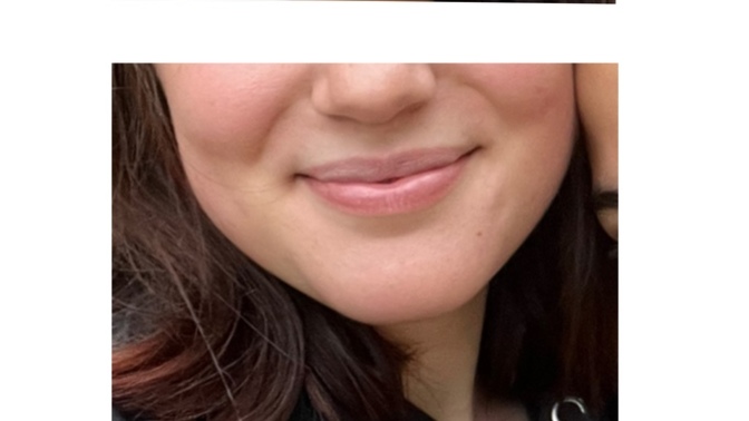 Yanaklarım neden böyle? Estetikle aldırayım mı, yan etkisi olur mu?