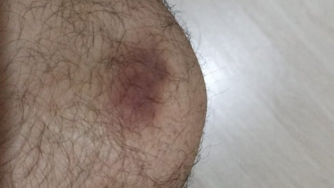 Eşim her sinirlendiğinde bana vuruyor. Dizim hep morluk içinde. Sizce boşanmalı mıyım? Psikiyatriye git dedim diye yapıyor?