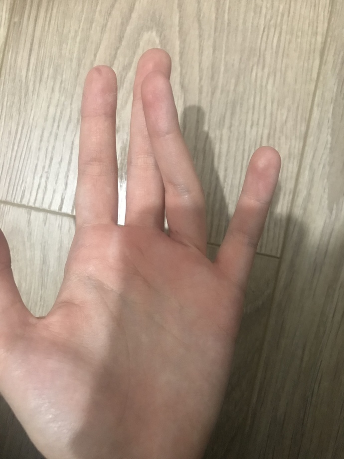 Annem parmağımı çevirdi. Ses çıktı açıyor şu an Sizce kırık mıdır incinmiş midir aşağıdaki gibi duruyor düz tutamıyorum yamuk?