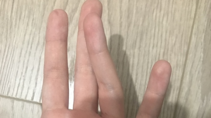 Annem parmağımı çevirdi. Ses çıktı açıyor şu an Sizce kırık mıdır incinmiş midir aşağıdaki gibi duruyor düz tutamıyorum yamuk?