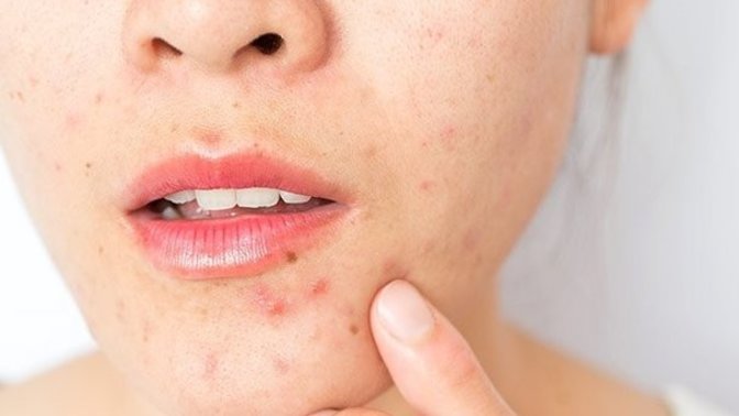 Sivilceler için en etkili gördüğünüz çözüm nedir?
