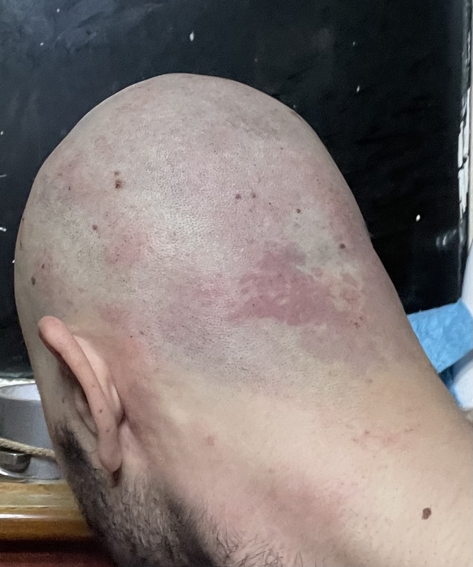 Saçlarımı sıfıra vurdum böyle izler var bunlar nedir?