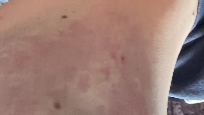 Saçlarımı sıfıra vurdum böyle izler var bunlar nedir?