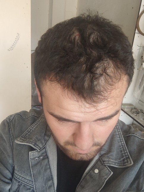 Saçlarım döküldü ne yapabilirim?