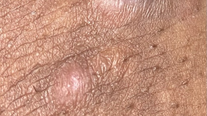 Özel bölgede çıkan sivilce benzeri büyük şey nedir?
